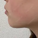 ボトックス（あご） / ヒアルロン酸注入（あご） / ボトックス（エラ・小顔） Next Tokyo Clinic AFTER サムネイル用