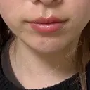 ボトックス（あご） / ヒアルロン酸注入（あご） / ボトックス（エラ・小顔） Next Tokyo Clinic DAY 0 サムネイル用