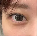 その他（目元） eクリニック 横浜みなとみらい院 DAY 12 サムネイル用