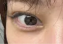 その他（目元） eクリニック 横浜みなとみらい院 AFTER サムネイル用
