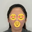 糸リフト / ヒアルロン酸注入（鼻翼基部） Olivia Clinic AFTER サムネイル用