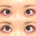 タレ目形成・グラマラスライン（切開） 形成外科と美容外科のクリニック池袋 DAY 15 サムネイル用