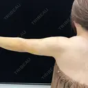 脂肪吸引（二の腕） EMMA CLINIC（エマクリニック） DAY 3 サムネイル用