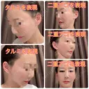 バッカルファット除去 / その他（輪郭） / 切開リフト / メーラーファット除去 / ジョールファット除去 / あご下筋肉縛り / ネックリフト / ヒアルロン酸注入（頬） / ヒアルロン酸注入（首） タシピウム整形外科 DAY 303 サムネイル用