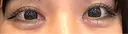 ヒアルロン酸注入（涙袋） プライベートスキンクリニック 梅田本院 DAY 0 サムネイル用