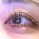 ヒアルロン酸注入（涙袋） プライベートスキンクリニック 梅田本院 DAY 0 サムネイル用