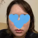 糸リフト / 脂肪吸引（顔） / ジョールファット除去 / 脂肪吸引注射（顔） SEA CLINIC（シークリニック） DAY 10 サムネイル用