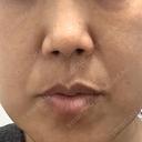 ピコレーザートーニング（美白・肝斑） サクラアズクリニック 大阪心斎橋院 DAY 0 サムネイル用