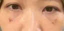 クマ治療 池袋麗歯科・美容皮膚科 DAY 18 サムネイル用