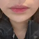 ボトックス（あご） / 肌ヒアルロン酸注入（たるみ・シワ改善） BIZENNクリニック【ビゼンクリニック】 DAY 0 サムネイル用