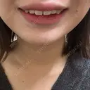 ボトックス（あご） / 肌ヒアルロン酸注入（たるみ・シワ改善） BIZENNクリニック【ビゼンクリニック】 DAY 2 サムネイル用