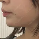 ボトックス（あご） / 肌ヒアルロン酸注入（たるみ・シワ改善） BIZENNクリニック【ビゼンクリニック】 DAY 2 サムネイル用
