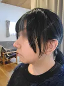 鼻尖形成（切開） / 鼻中隔延長（切開） / 小鼻縮小（切開） / 軟骨移植 / 骨切幅寄せ / 鼻柱下降・鼻唇角形成（猫手術） WOM CLINIC GINZA （ワム クリニック ギンザ） AFTER サムネイル用