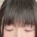 二重切開 / 眼瞼下垂（切開） 広島プルミエクリニック DAY 80 サムネイル用