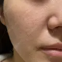 ヴェルヴェットスキン 形成外科と美容外科のクリニック池袋 DAY 17 サムネイル用