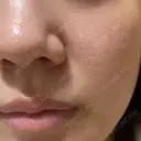 ヴェルヴェットスキン 形成外科と美容外科のクリニック池袋 DAY 17 サムネイル用