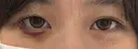 ヒアルロン酸注入（涙袋） / ヒアルロン酸注入（唇） 共立美容外科 梅田院 AFTER サムネイル用