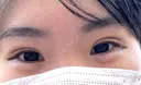 二重埋没 共立美容外科 大宮院 DAY 28 サムネイル用