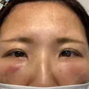 クマ治療 湘南美容クリニック 千葉センシティ院 DAY 1 サムネイル用