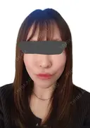 シワ取りボトックス / ピコレーザートーニング（美白・肝斑） / ピコフラクショナルレーザー（毛穴・ニキビ跡） 東京シルククリニック 東京神田院 AFTER サムネイル用