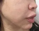 糸リフト / ボトックス（口角） 形成外科と美容外科のクリニック池袋 DAY 5 サムネイル用