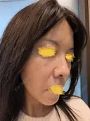 毛穴洗浄（ハイドラフェイシャルなど） Zetith Beauty Clinic 池袋院 DAY 0 サムネイル用