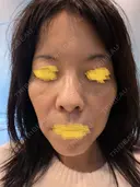 毛穴洗浄（ハイドラフェイシャルなど） Zetith Beauty Clinic 池袋院 DAY 0 サムネイル用