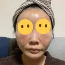 糸リフト / 脂肪吸引（顔） / 下まぶたの脂肪取り / 脂肪注入（額） / メーラーファット除去 / 脂肪注入（目の下） SEA CLINIC（シークリニック） DAY 1 サムネイル用