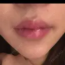 ボトックス（あご） / ボトックス（口角） ルラ美容クリニック 岐阜院 AFTER サムネイル用