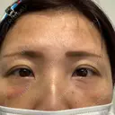 クマ治療 湘南美容クリニック 千葉センシティ院 DAY 2 サムネイル用