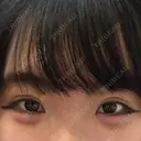 二重埋没 共立美容外科 大宮院 DAY 11 サムネイル用