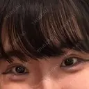 二重埋没 共立美容外科 大宮院 DAY 12 サムネイル用
