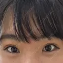 二重埋没 共立美容外科 大宮院 DAY 94 サムネイル用
