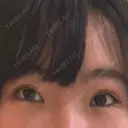 二重埋没 共立美容外科 大宮院 AFTER サムネイル用