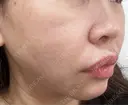 糸リフト / ボトックス（口角） 形成外科と美容外科のクリニック池袋 DAY 6 サムネイル用