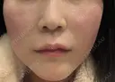 肌ヒアルロン酸注入（たるみ・シワ改善） / ヒアルロン酸注入（唇） / ヒアルロン酸注入（頬） / シワ取りボトックス / ボトックス（眉間） / ボトックス（額） LE CLINIC DAY 1 サムネイル用