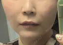 肌ヒアルロン酸注入（たるみ・シワ改善） / ヒアルロン酸注入（唇） / ヒアルロン酸注入（頬） / シワ取りボトックス / ボトックス（眉間） / ボトックス（額） LE CLINIC DAY 1 サムネイル用