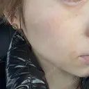 水光注射（ハリ・美肌） REVI CLINIC銀座院  AFTER サムネイル用