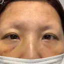 クマ治療 湘南美容クリニック 千葉センシティ院 AFTER サムネイル用