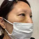 クマ治療 湘南美容クリニック 千葉センシティ院 DAY 3 サムネイル用
