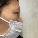 クマ治療 湘南美容クリニック 千葉センシティ院 DAY 3 サムネイル用