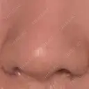 小鼻縮小（切開） EMMO FACE CLINIC 東京三田院 AFTER サムネイル用