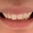 ボトックス（口角） BON BON CLINIC 渋谷院 DAY 10 サムネイル用