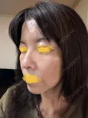 毛穴洗浄（ハイドラフェイシャルなど） Zetith Beauty Clinic 池袋院 DAY 2 サムネイル用