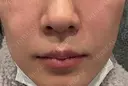 鼻翼基部形成（貴族手術） / ヒアルロン酸注入（鼻翼基部） ルラ美容クリニック 福岡天神院 DAY 0 サムネイル用