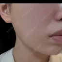 ピーリング（ハリ・ツヤ） / ルメッカ 大美会クリニック 梅田院 AFTER サムネイル用