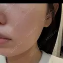 ピーリング（ハリ・ツヤ） / ルメッカ 大美会クリニック 梅田院 DAY 2 サムネイル用