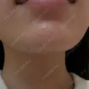 ピーリング（ハリ・ツヤ） / ルメッカ 大美会クリニック 梅田院 DAY 2 サムネイル用