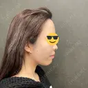 糸リフト / 脂肪吸引（顔） ネビュラクリニック 京都院 DAY 0 サムネイル用