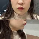 ボトックス（エラ・小顔） BiBiクリニック DAY 0 サムネイル用